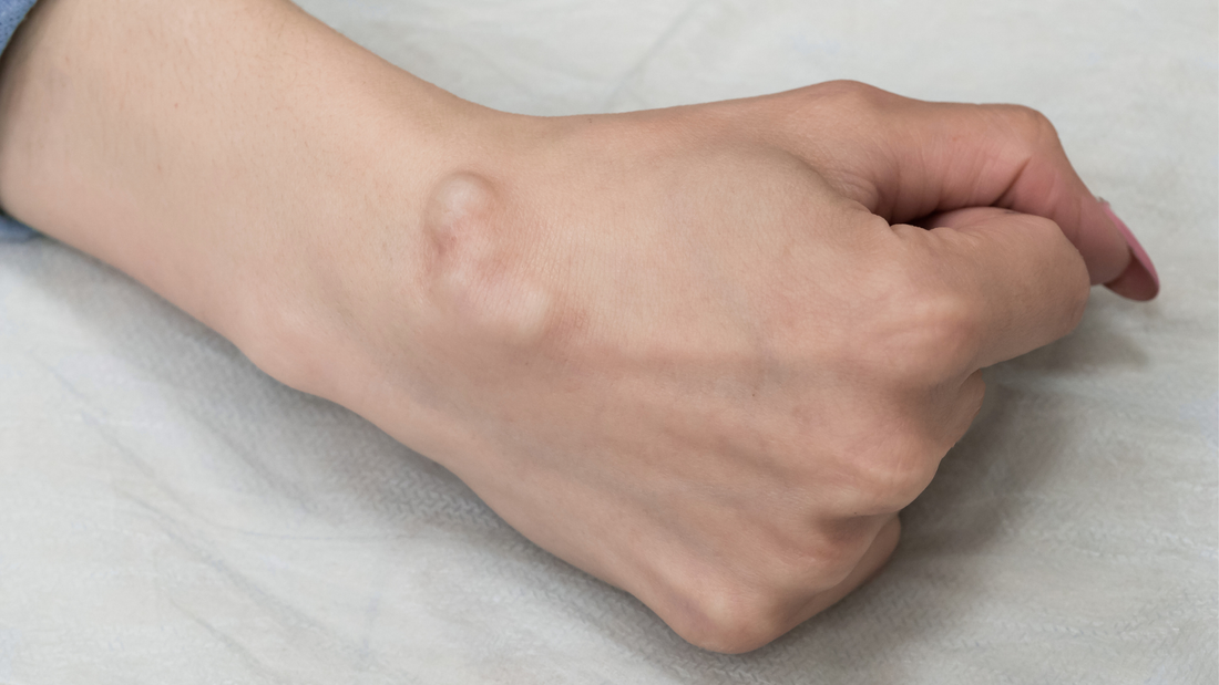 Soigner kyste avec complément alimentaire naturel